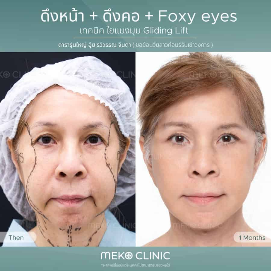 ดึงหน้าเทคนิค Gliding Brow Lift (ดึงหน้าเทคนิคใยแมงมุม) 1 เดือน