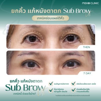 รีวิววยกคิ้ว Subbrow lift เมโกะ