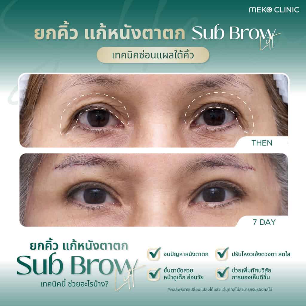 รีวิววยกคิ้ว Subbrow lift เมโกะ