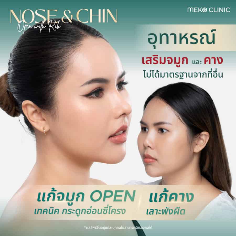 แก้จมูกโอเพ่นเทคนิคกระดูกอ่อนซี่โครง + แก้คางซิลิโคนขายาว