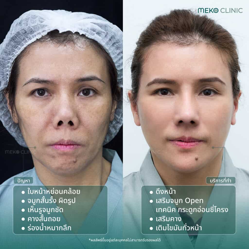 ก่อนทำ-แก้จมูกopen-ดึงหน้า-เสริมคาง-เติมไขมัน-4