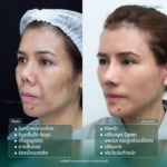 รีวิวแก้จมูกopen-ดึงหน้า-เสริมคาง-เติมไขมัน