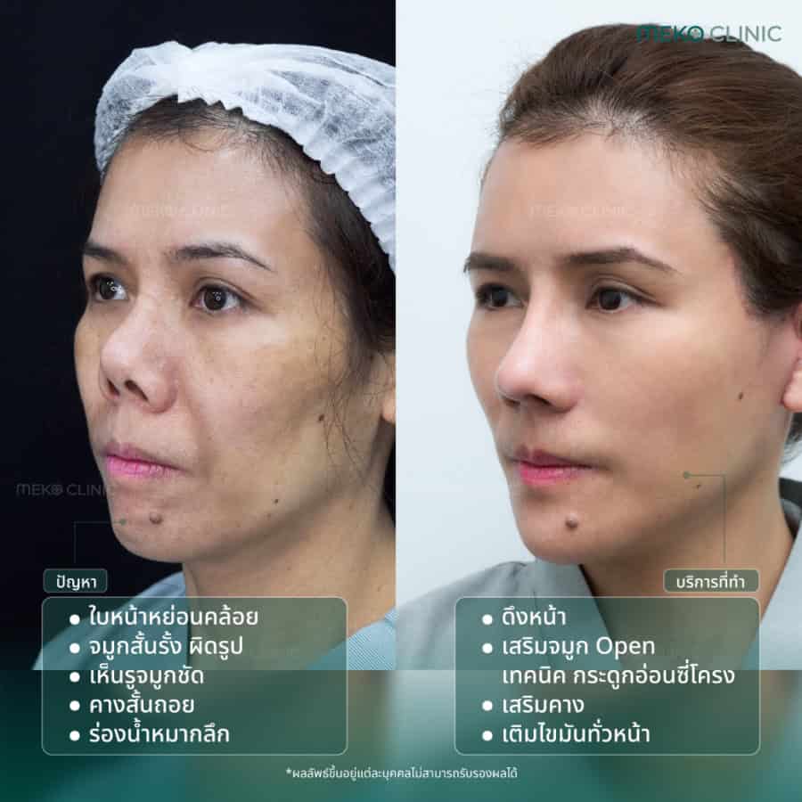 รีวิวแก้จมูกopen-ดึงหน้า-เสริมคาง-เติมไขมัน