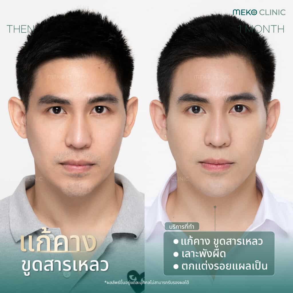 แก้คางขูดสารเหลว คุณแม็ก เดอะสตาร์