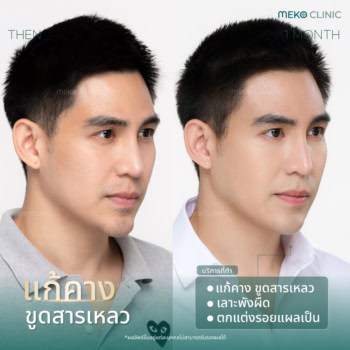 อุทาหรณ์ คางผิดรูป เพราะสารสารเหลวที่คาง คุณแม็ก เดอะสตาร์