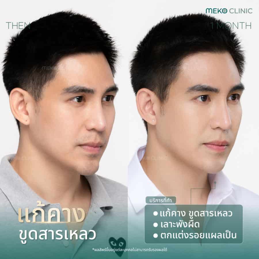 อุทาหรณ์ คางผิดรูป เพราะสารสารเหลวที่คาง คุณแม็ก เดอะสตาร์