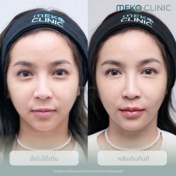 รีวิวฉีดfiller ใต้ตา ขมับ ปากจอย ไกอา-2