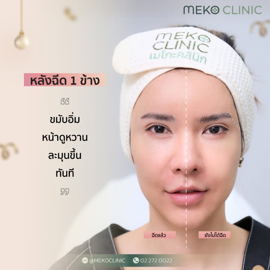 ฟิลเลอร์ขมับ ปรับโหงวเฮ้ง ปรับรูปหน้า