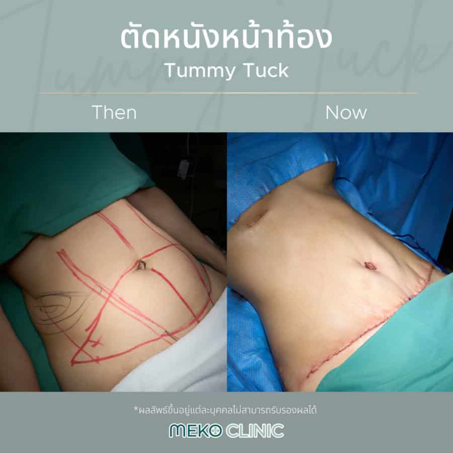 ตัดหนังหน้าท้อง Tummy Tuck เมโกะ