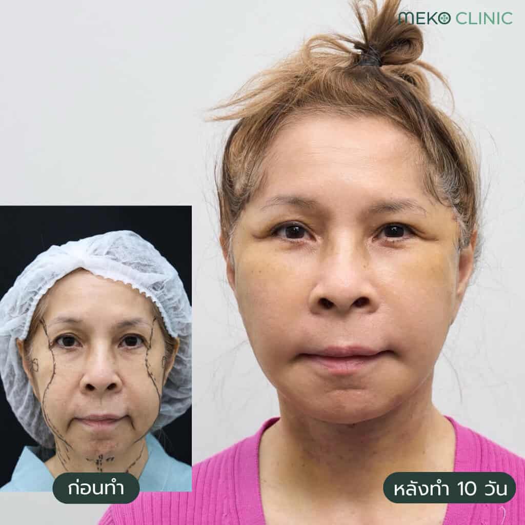 ศัลยกรรมดึงหน้า เทคนิค Gliding Brow Lift (ดึงหน้าเทคนิคใยแมงมุม) อุ้ย รวิวรรณ-2