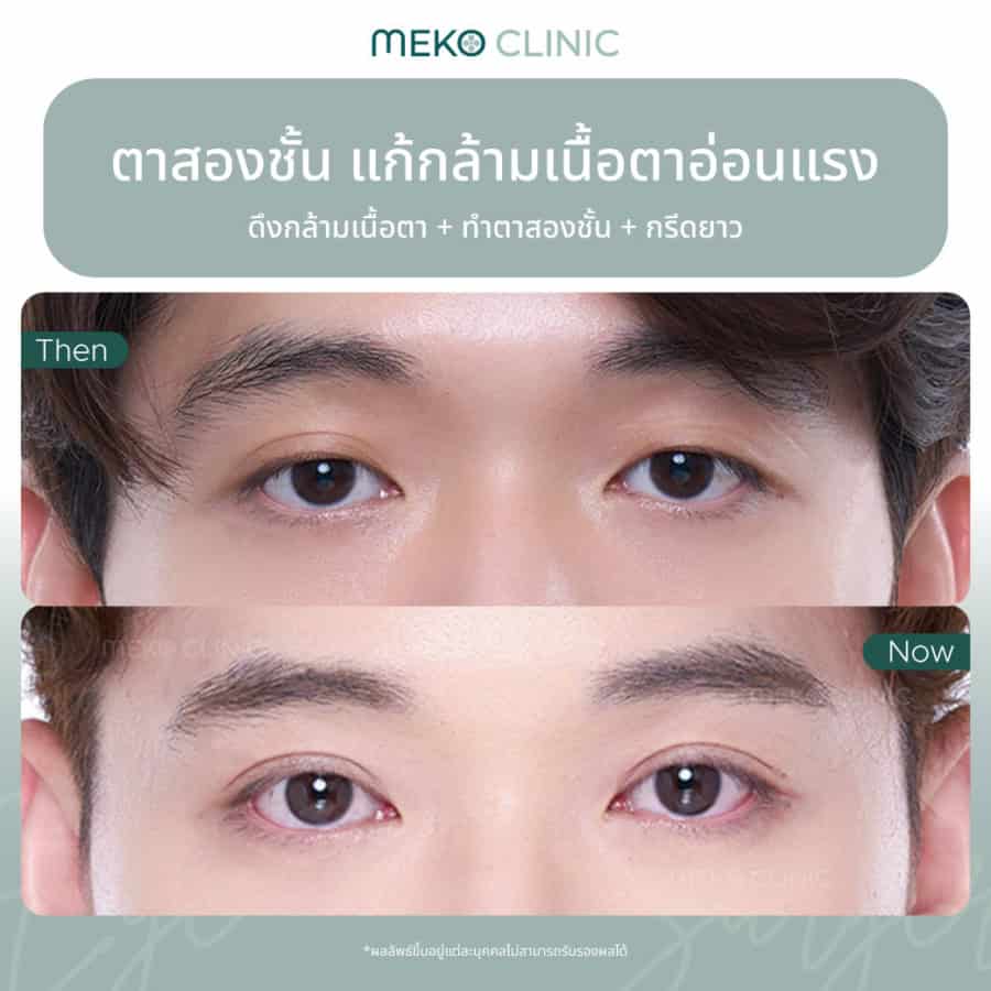 ตาสองชั้น แก้กล้ามเนื้อตาอ่อนแรง ดึงกล้ามเนื้อตา+ทำตาสองชั้น+กรีดยาว