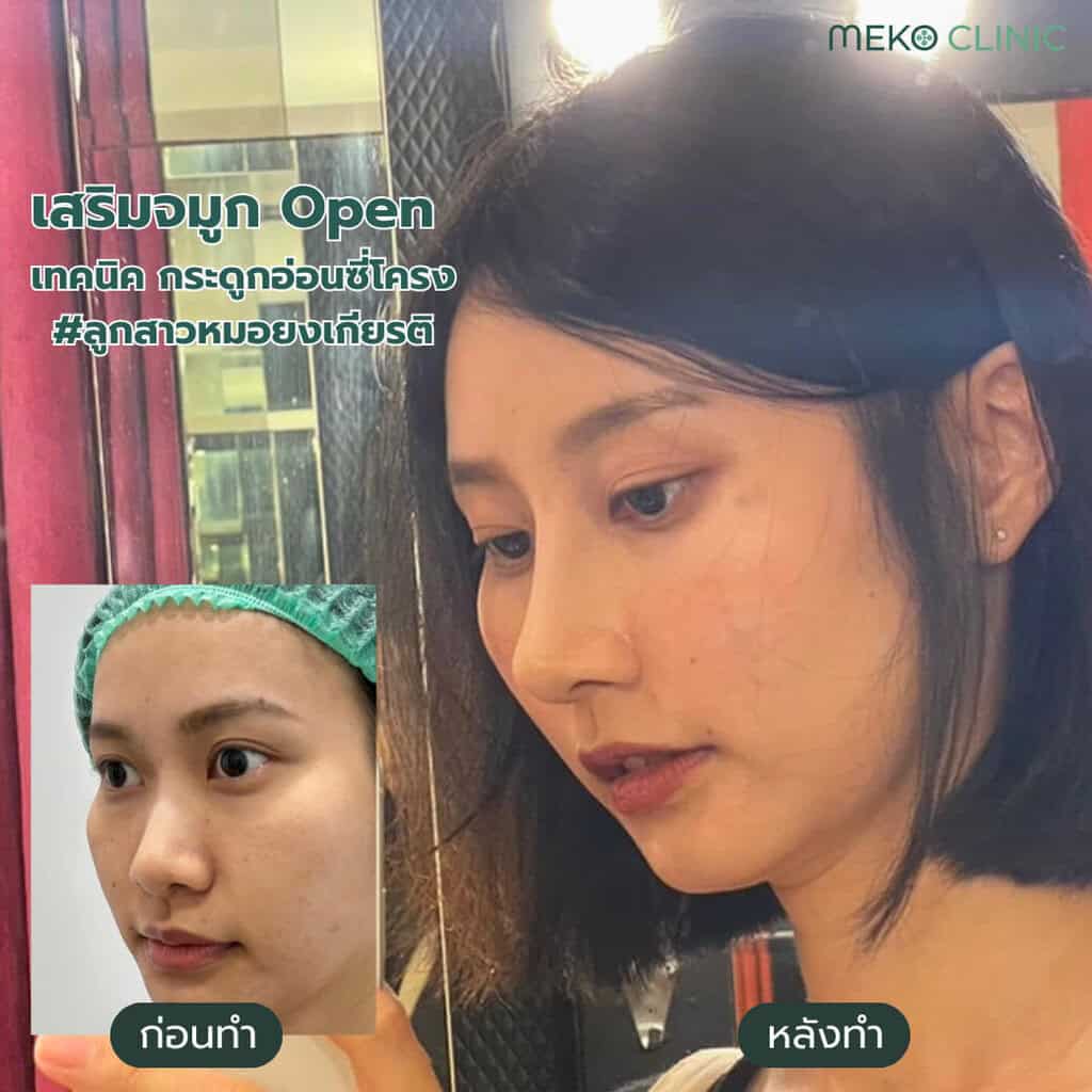 เสริมจมูก-Open-เทคนิค-กระดูกอ่อนซี่โครง
