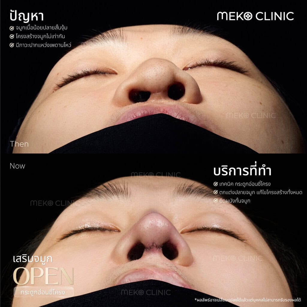 banner-เสริมจมูก-คุณพีรยา-open-หมอกานต์-01