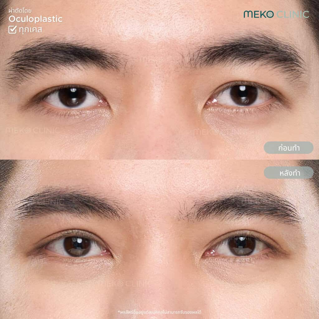 ตาสองชั้น+กล้ามเนื้อตาอ่อนแรง