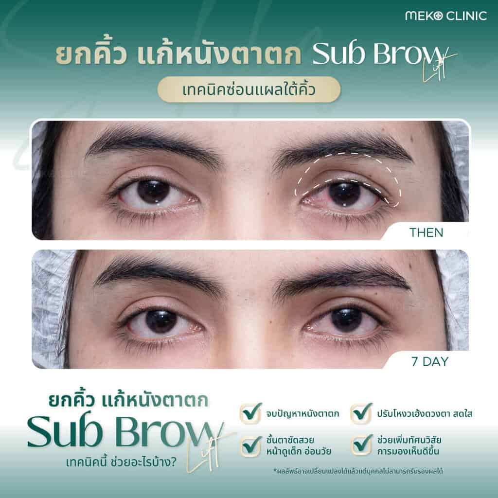 รีวิว-ตาสองชั้น-Subbrow-คุณโบว์ลิ่ง-หมอเป็นเอก-01