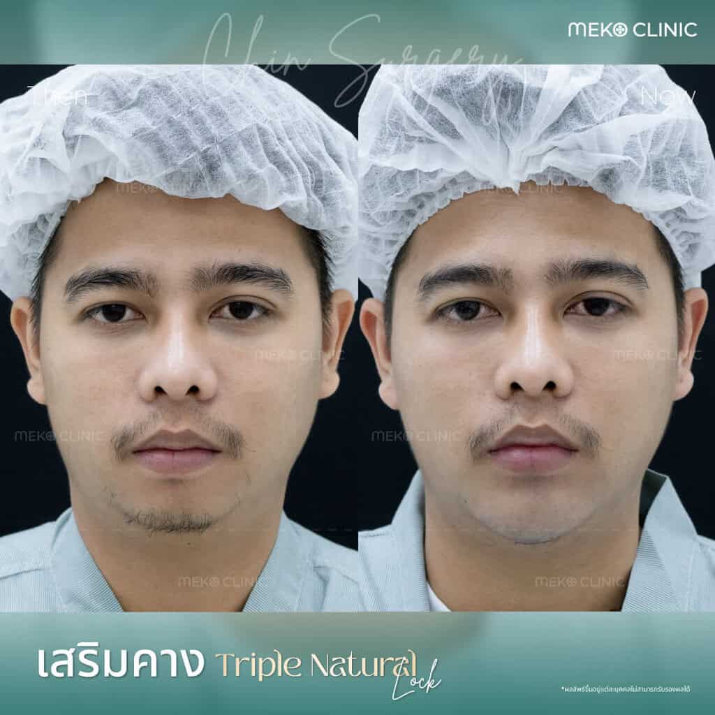 รีวิว-เสริมคาง-ผู้ชาย-คุณณัฐชนน-หมอยง-01