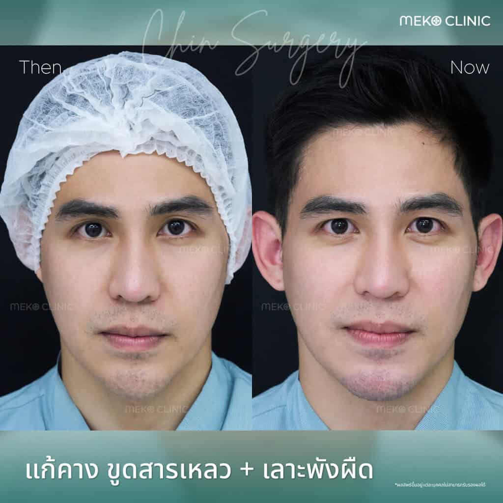 รีวิว-เสริมคาง-แก้คาง-ขูดสารเหลว-คุณแม็ก-หมอมนัส-01