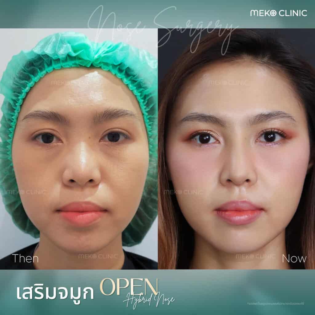 รีวิว-เสริมจมูก-open-นพวรรณ-หมอกานต์-01