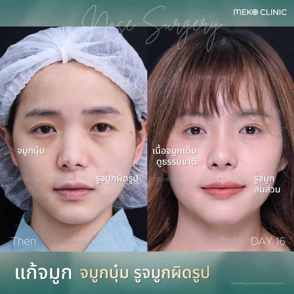รีวิว-เสริมจมูก-คุณธัญญลักาณ์-หมอมนัส-01