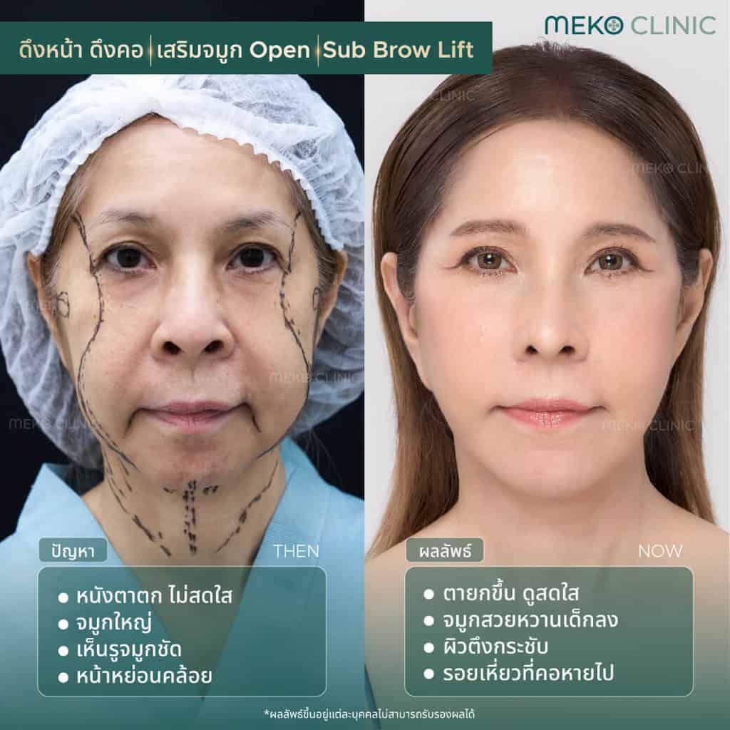 รีวิวศัลยกรรมดึงหน้า ดึงคอ เสริมจมูก และ ยกคิ้ว(Subbrow) โดยคุณอุ้ย-1