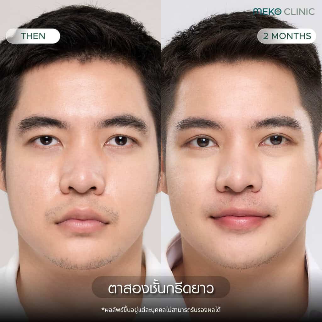 รีวิวศัลยกรรมตาสองชั้นแบบกรีดยาว โดยคุณเพรช-1