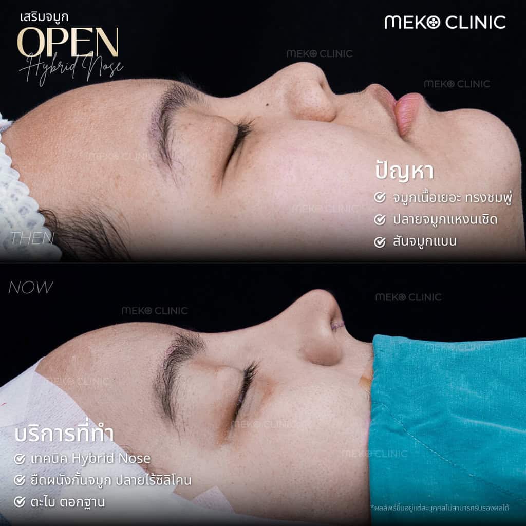 รีวิวศัลยกรรมเสริมจมูกเทคนิค Open คุณณัฏฐ์ฤทัย-1