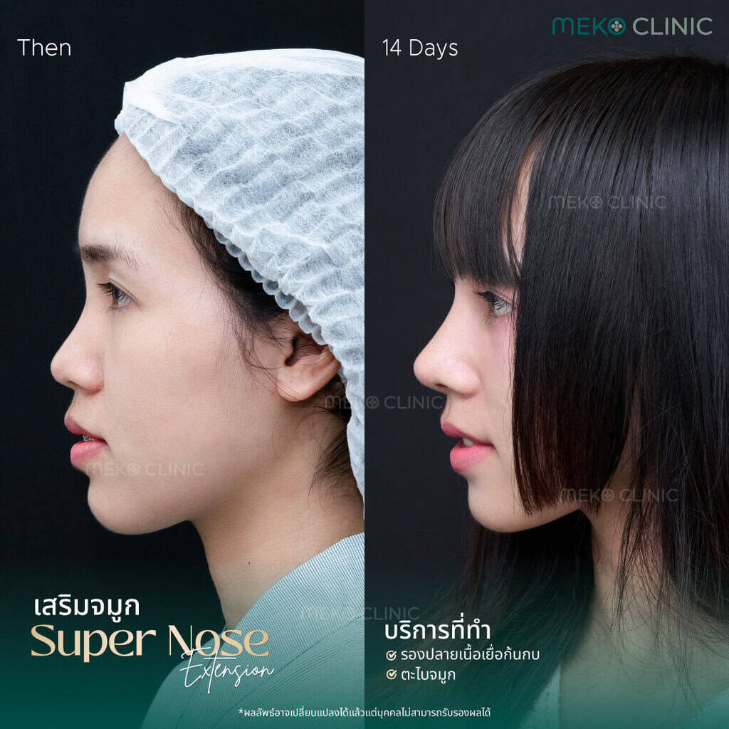 รีวิวศัลยกรรมเสริมจมูกแบบปิด เทคนิค SuperNose Extension โดยคุณวัลย์ลัดดา-1