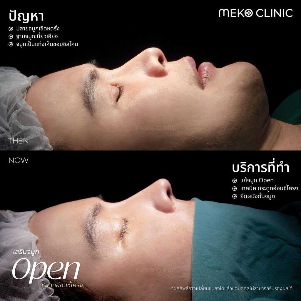 รีวิวศัลยกรรมแก้จมูกเทคนิค Open ด้วยซี่โครง พร้อมทั้งยืดผนังกั้นจมูก -1
