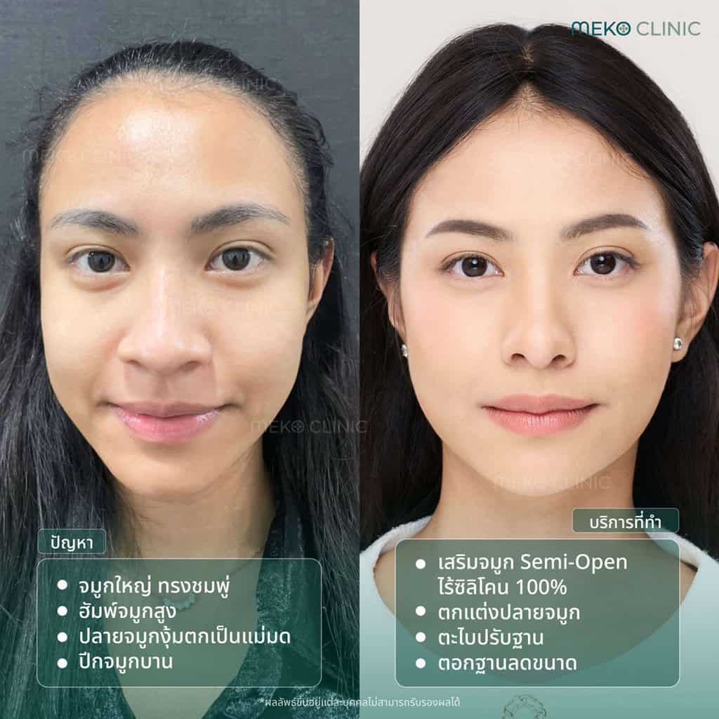 รีวิวเสริมใหม่จมูกเทคนิค Semi Open ไร้ซิลิโคน คุณพรนิภา-1