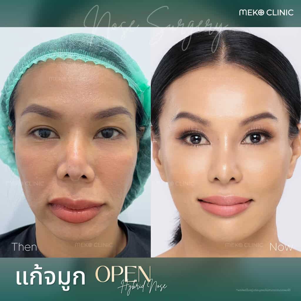 ศัลยกรรมแก้จมูก ด้วยเทคนิค Open ใช้ส่วนของหลังหู โดยคุณออย-1